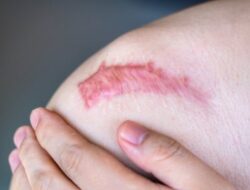 Mengenali dan Mengatasi Keloid: Panduan Lengkap untuk Kulit Sehat